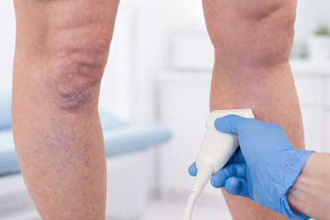 Венозный рефлюкс: что это такое и почему он опасен для ног